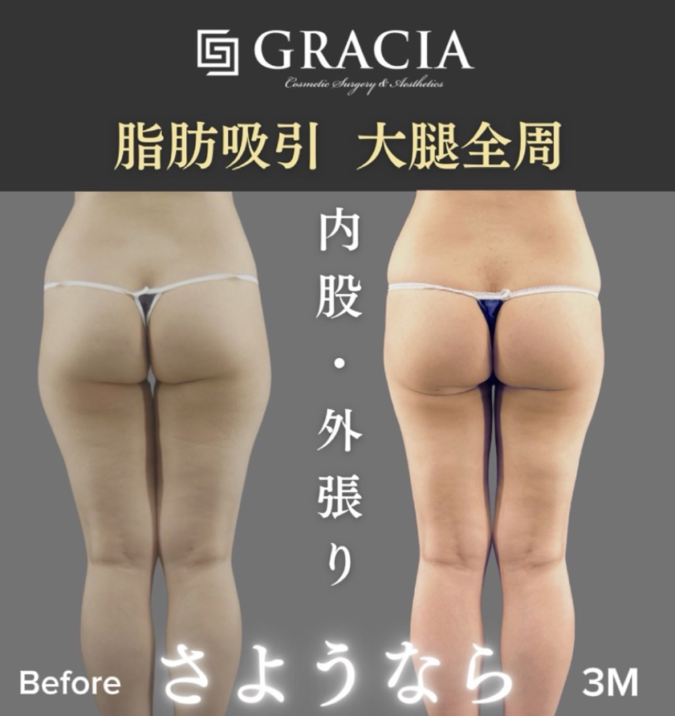 大腿全周の脂肪吸引（後ろ）手術前と手術後3か月