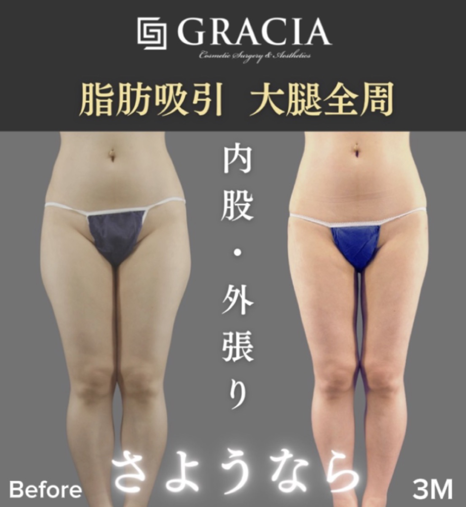大腿全周の脂肪吸引（正面）手術前と手術後3か月