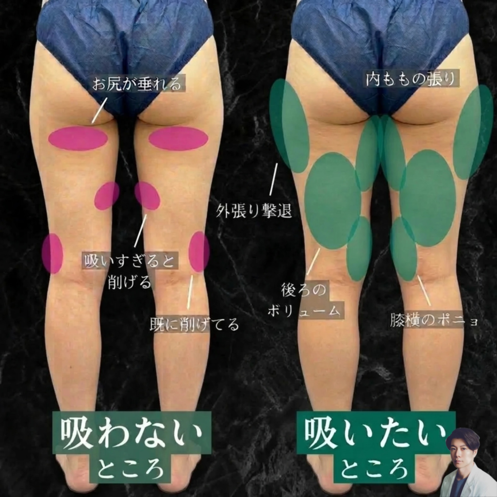 太ももの後ろ側のデザインの考え方